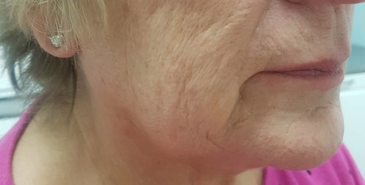 CACI Non-Surgical Face Lift Before & After - Winslow Skincare