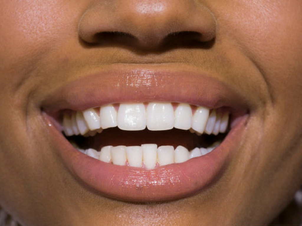 Top 10+ why am i breaking out around my mouth 1 Breakouts around the mouth - how to clear them up quickly!